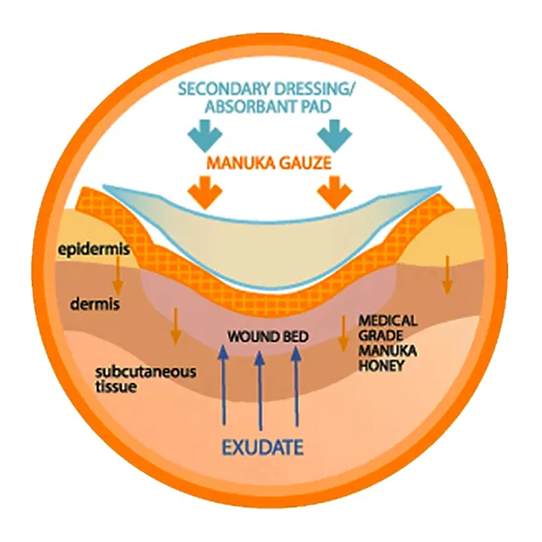 Medical Functional Honey Gauze Dressing for Wound Care